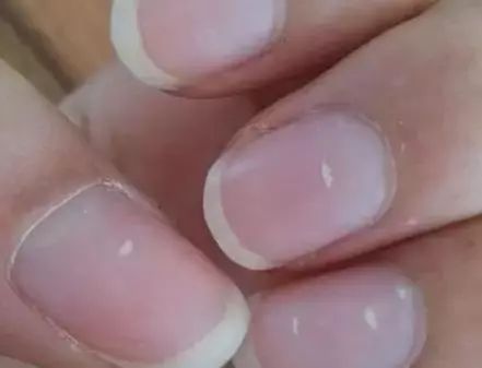 孩子指甲軟薄易斷、月牙少、長白點、豎紋是顯示身體有健康風(fēng)險嗎？(圖6)