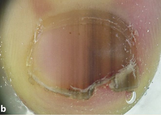 孩子指甲軟薄易斷、月牙少、長白點、豎紋是顯示身體有健康風(fēng)險嗎？(圖8)