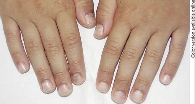 孩子指甲軟薄易斷、月牙少、長白點、豎紋是顯示身體有健康風(fēng)險嗎？(圖10)