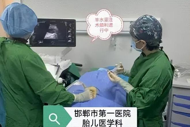 【邯鄲首例】邯鄲市第一醫(yī)院成功實施胎兒羊水灌注術(shù)(圖2)
